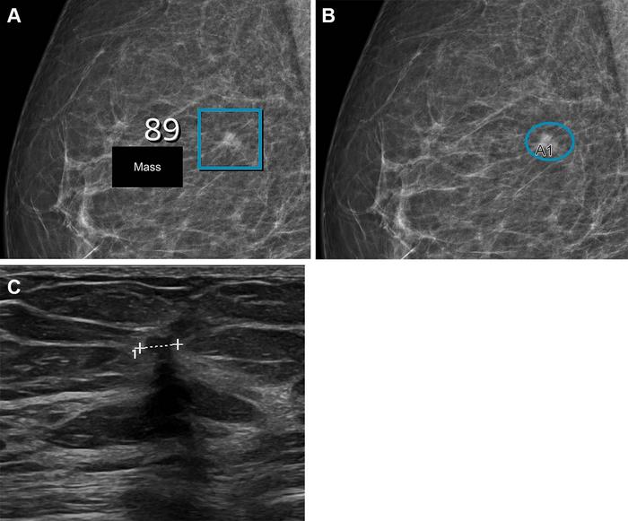 Images in a woman who had a BI-RADS density of 2.