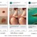 Social media ads may be effective in increasing melanoma knowledge and skin check confidence