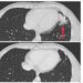 Cross-sectional CT images showing a metastatic tumor and no tumor following treatment