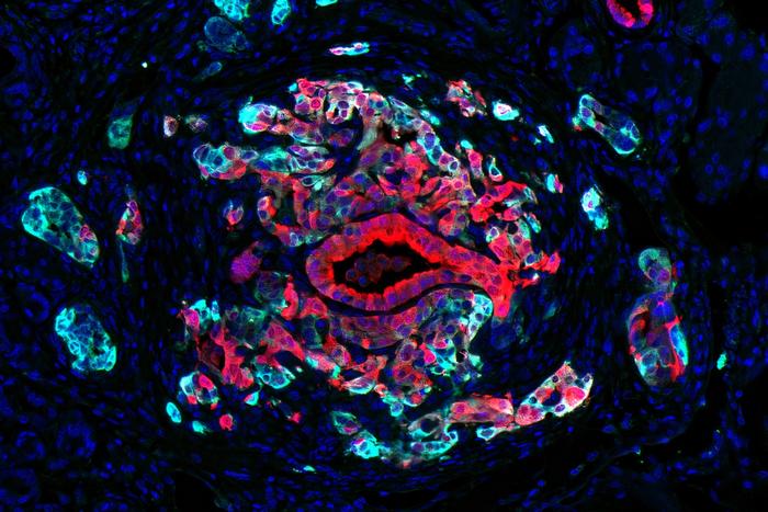 Pancreatic Cancer Cells