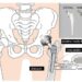 Artificial hip and two types of replacement stems