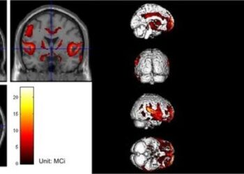 PET scan of a patient with iNPH. The imaging showed that focal decrease in metabolism in the bilateral medial, cingulate gyrus, parietal, insular, and caudate nuclei, bilateral thalamus, and midbrain, especially bilateral ventricles and the peripheral thi