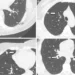 Representative chest low-dose CT images show lung nodules (arrows)