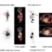 Molecular imaging of 7-wk-old girl with neuroblastoma.