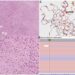 Rapid but nondurable response of a BRAF exon 15 double-mutated spindle cell sarcoma to a combination of BRAF and MEK inhibitors