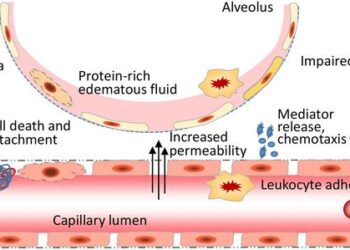 Endothelial barrier disruption leads to Acute Respiratory Distress Syndrome (ARDS)