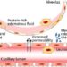 Endothelial barrier disruption leads to Acute Respiratory Distress Syndrome (ARDS)