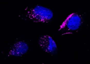 An image of head and neck cancer cells (in blue) treated with exosomes (in magenta)