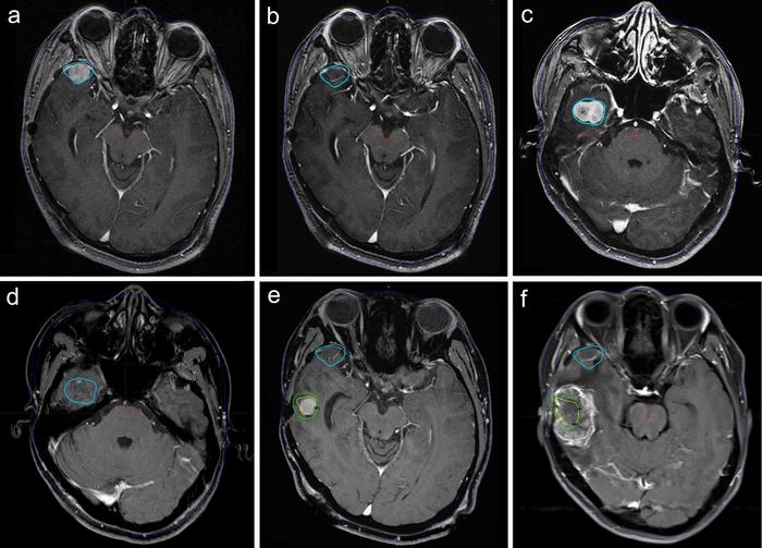 This figure illustrates a patient who had previously undergone two resections and one EBRT before undergoing GKRS for two recurrences