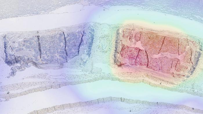 In the right half of this tissue section, engineered immune cells known as CAR T cells are attacking tumor tissue. A new method makes it possible to visualize them in the body using PET imaging, as shown here in the superimposed image.