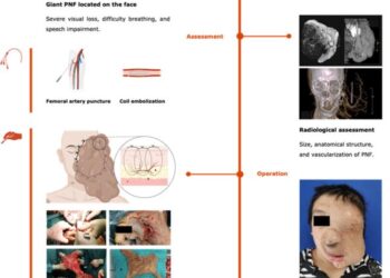 Workflow of the entire process before, during, and after surgery of a 31-year-old female with giant PNF on the left face.