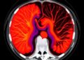 AI/ML Advances in LDCT Reconstruction: A Review