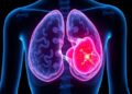 New Insights on Breast Cancer Metastasis Biomarkers