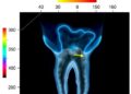 AI Predicts Tooth Extraction with Limited Imaging Data