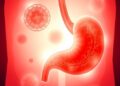 Acute Pancreatitis Worsens Outcomes in Pediatric Stem Cell Patients