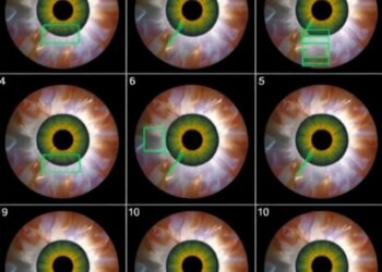 Exploring Machine Learning in Strabismus Surgery Predictions