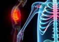 Osteoporosis Risk in CKD Patients Over 50 Uncovered