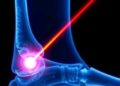 Breakthrough Achievement: Laser Penetrates Bone to Unprecedented Depths