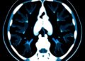 AI-Powered CT Scan Analysis Promises to Accelerate Clinical Assessments