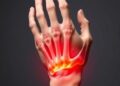Early Arthritis Impacts Pain, Behavior, and Brain Factors