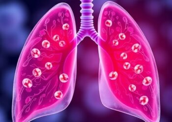 Inhibiting Lipid Production in Healthy Lung Cells May Decrease Lung Metastasis
