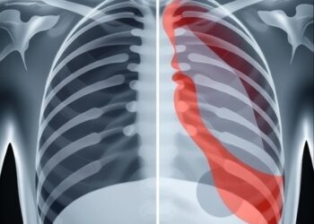 Total Thoracoscopic vs. Small-Incision Surgery: Rib Fracture Study