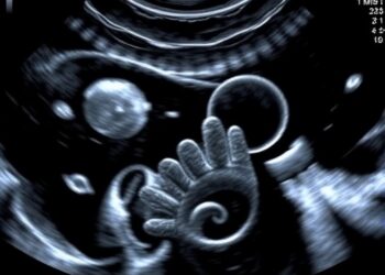 Ultrasound Protocol Reduces Bleeding in Preterm Infants