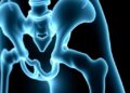 Breakthrough Genetic Discoveries Unveil New Perspectives on Developmental Dysplasia of the Hip