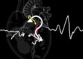 Echocardiographic Insights into Diastolic Dysfunction in CDH