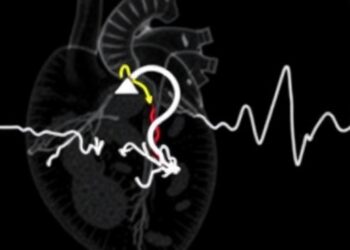 Echocardiographic Insights into Diastolic Dysfunction in CDH