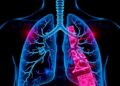 Lung Cancer That Alters Its Identity Could Be Concealed in Plain Sight