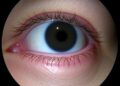 New Early Sjogren’s Diagnosis via Lacrimal Doppler