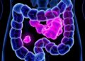 Oncofetal Plasticity Emerges in Early Colorectal Cancer