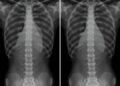Preop T1 Slope Minus Lordosis Predicts Surgery Outcomes