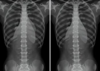 Preop T1 Slope Minus Lordosis Predicts Surgery Outcomes