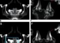 SNPs in FILIP1-SENP6, FTO Linked to TMJ Osteoarthritis