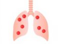 Blood Count Links to Severe Pediatric Pneumonia Outcomes — Technology and Engineering