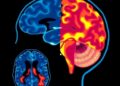 Brain Scans Uncover Two Biologically Distinct Subtypes of Autism — Biology