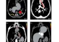 Comparing Sequential Transarterial Chemoembolization After Stereotactic Body Radiation Therapy to Radiation Alone in Treating Recurrent Hepatocellular Carcinoma — Cancer