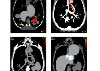 Comparing Sequential Transarterial Chemoembolization After Stereotactic Body Radiation Therapy to Radiation Alone in Treating Recurrent Hepatocellular Carcinoma — Cancer