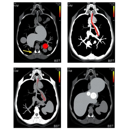 Comparing Sequential Transarterial Chemoembolization After Stereotactic Body Radiation Therapy to Radiation Alone in Treating Recurrent Hepatocellular Carcinoma — Cancer