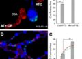 CsA+ATG Outperforms CsA Alone in Pediatric Aplasia — Technology and Engineering