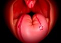 Insights into Congenital H-Type Tracheoesophageal Fistula — Technology and Engineering