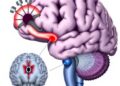 Language Plasticity in Anaesthetized Human Hippocampus — Medicine