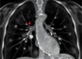 Lung Ultrasound Detects Necrosis in Pediatric Pneumonia — Technology and Engineering