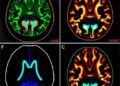 Metabolomic Profiling Uncovers Subtype-Specific Pathways in Pediatric Ependymoma — Biology