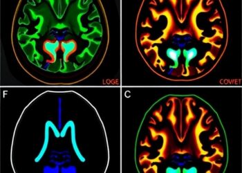 Metabolomic Profiling Uncovers Subtype-Specific Pathways in Pediatric Ependymoma — Biology