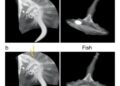 Minimally Invasive Ultrasound-Guided Endoscopic Retrieval of Deeply Embedded Cervical Fish Bone Following Unsuccessful Open Surgery — Biology