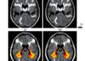 New Insights into Unilateral Meniere’s Disease Patients Lacking Endolymphatic Hydrops via MRI Analysis — Biology