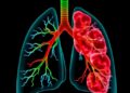 Scientists Identify Biomarker Linked to Chemotherapy Resistance in Relapsed Lung Cancer — Cancer